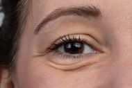 Sunken eyes (Image via Getty Images/Srulik)